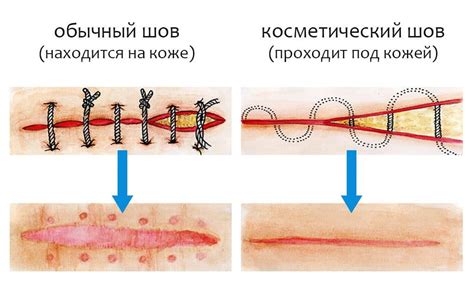 Частые ошибки, препятствующие естественному рассасыванию швов при заживлении раны