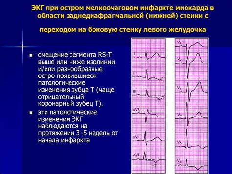 ЭКГ - неотъемлемый инструмент в выявлении изменений сердечной мышцы левого камерного отдела