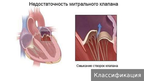  Врожденные аномалии, приводящие к несостоятельности остиального клапана 