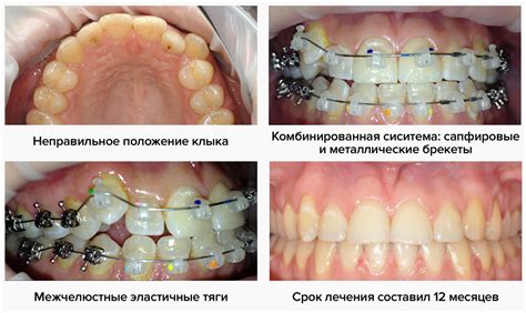  Создание основания для ортодонтической конструкции 